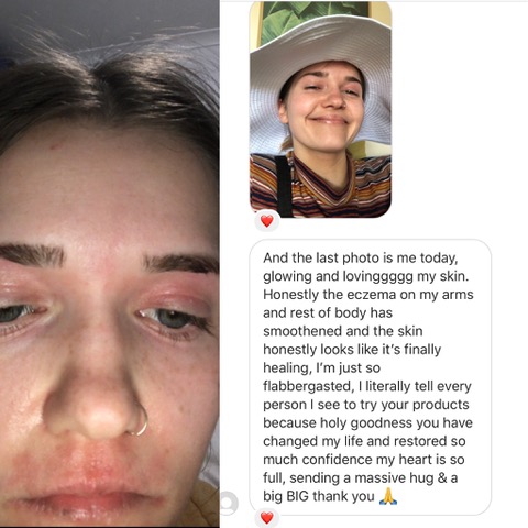 facial eczema, Why Hemp Jelly works for facial eczema, Cannabella