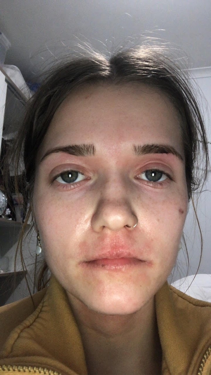 Treat facial eczema., Facial Eczema Results With Hemp Seed Oil, Cannabella